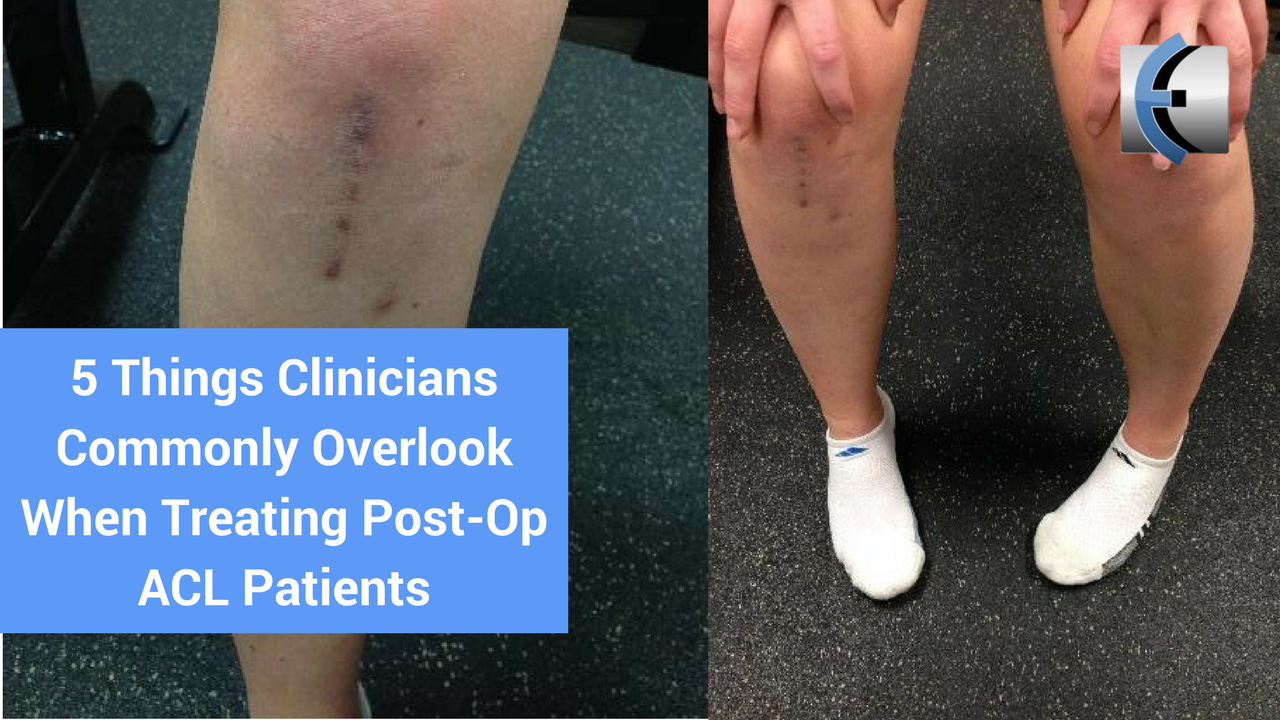 5 Things Clinicians Commonly Overlook When Treating PostOp ACL