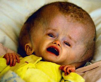 Nuclear and Radiation Disaster Nuclear and Radiation Disaster