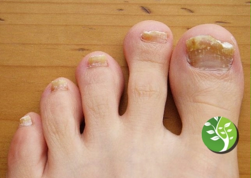 uñas de los pies amarillas: causas, tratamiento y cómo prevenirlo