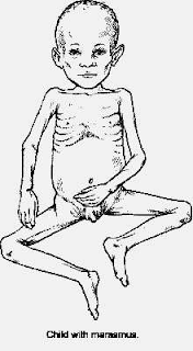 मरास्मस (Marasmus)