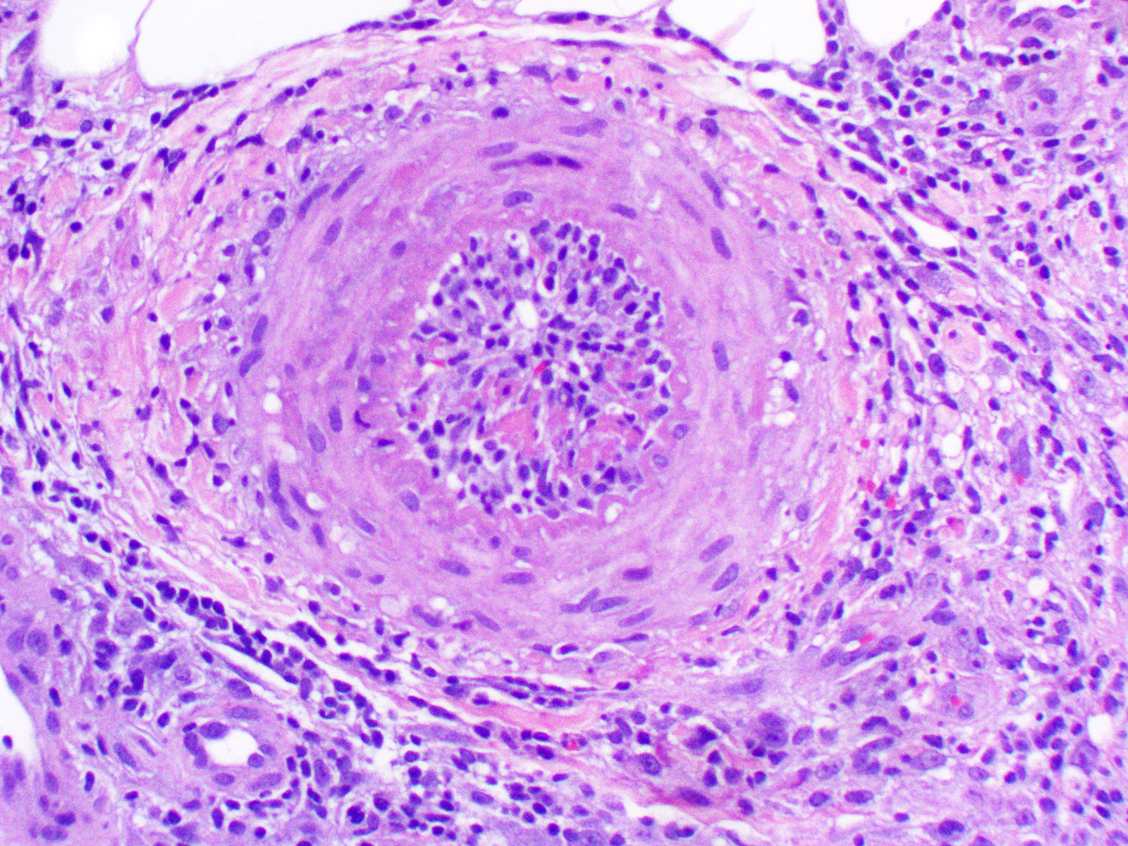 VIRTUAL GRAND ROUNDS IN DERMATOLOGY 2.0 54 yo man with necrotizing