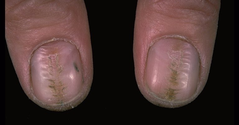 causes of splitting nails #10