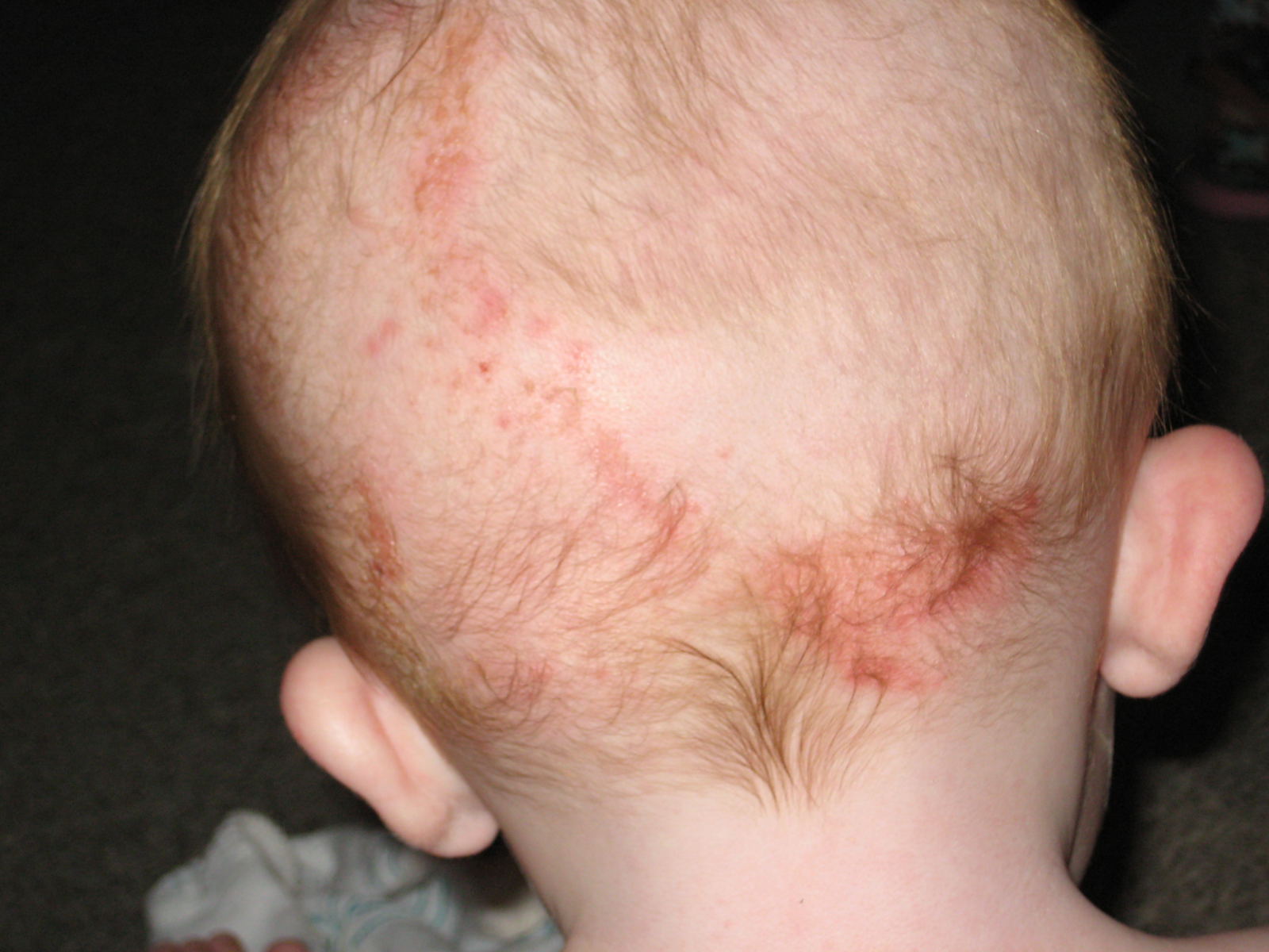 Head rash Treatments - RightDiagnosis.com