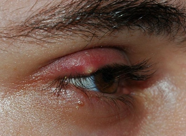 Eyelid Inflammation (Blepharitis) - Healthline