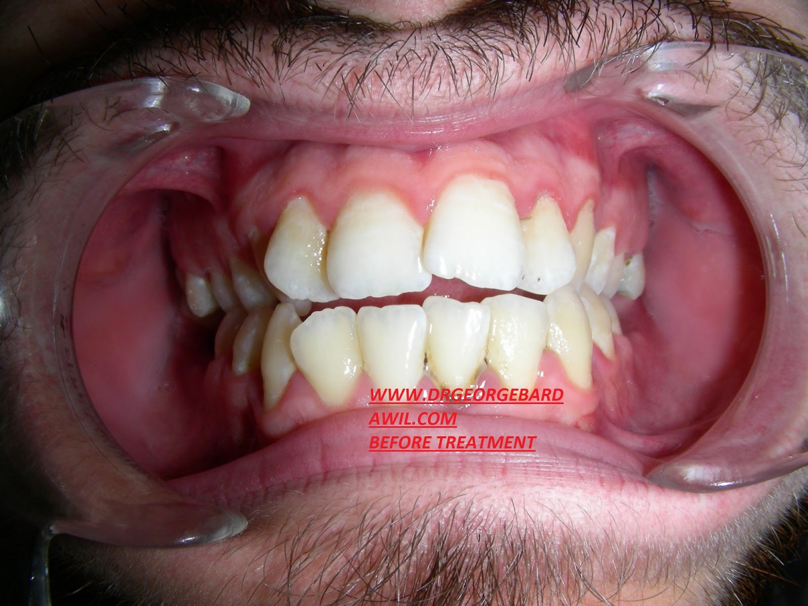 E. BardawilOrthodontistInvisalign Diamond level OPEN BITE