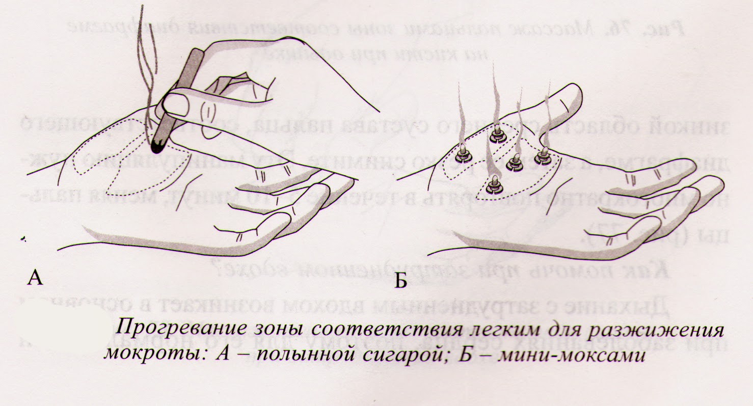 прогрев легких. магнито-лазерная терапия аппарат. уфо физиотерапия дрт400. аппарат ивл dräger carina. бронхообструктивный синдром рентген.