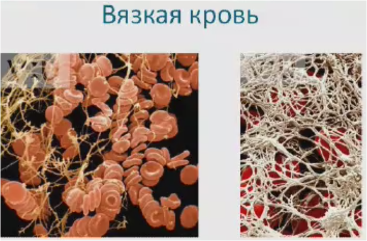 Густая кровь причины у женщин. Симптомы вязкой. Густая кровь симптомы у женщин. Симптомы вязкой. Симптомы вязкой.