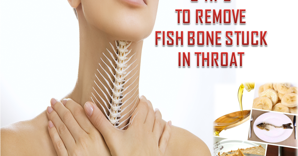 How Do You Remove A Fish Bone From Your Throat? 8 TIPS TO REMOVE FISH