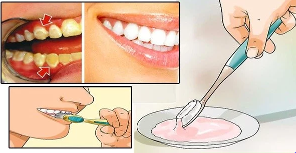 Get Rid Of Dental Plaque In Only 5 Minutes