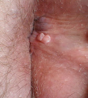 Genital Warts Public Health Gibraltar