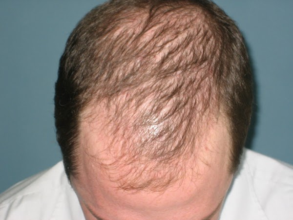 Amazing Homeopathic medicine combination that activates hair follicle , regrow hair and stop further hairloss, Try it and Make Possible to impossible for bald head Amazing Homeopathic medicine combination that activates hair follicle , regrow hair and stop further hairloss, Try it and Make Possible to impossible for bald head