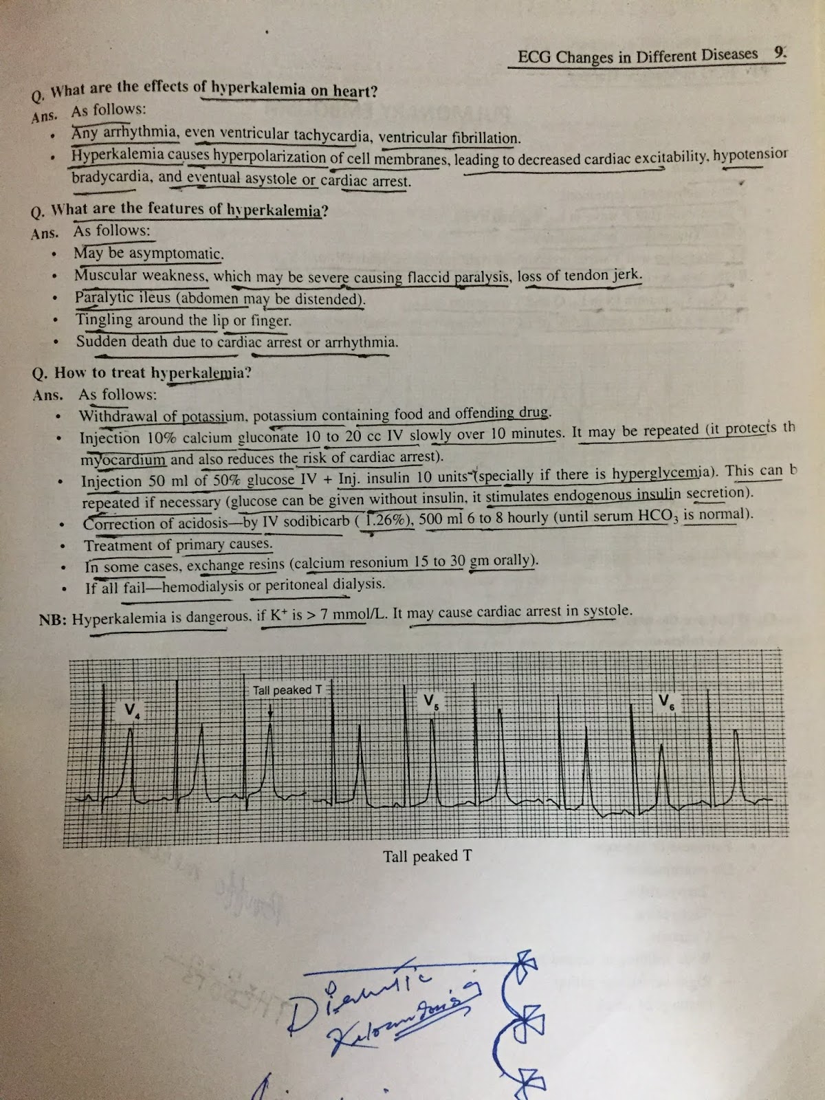 ECG DIGITALIS EFFECT ,HYPOKALEMIA AND HYPERKALEMIA
