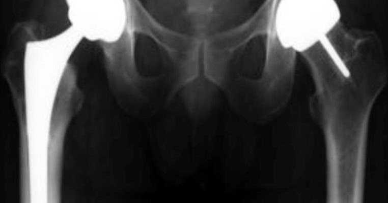 Замена сустава инвалидность дают. Эндопротезирование головки бедренной кости. Замена сустава инвалидность дают. Коксартроз 2-3 степени тазобедренного сустава. Эндопротезирование тазобедренного сустава инвалидность положена ли.