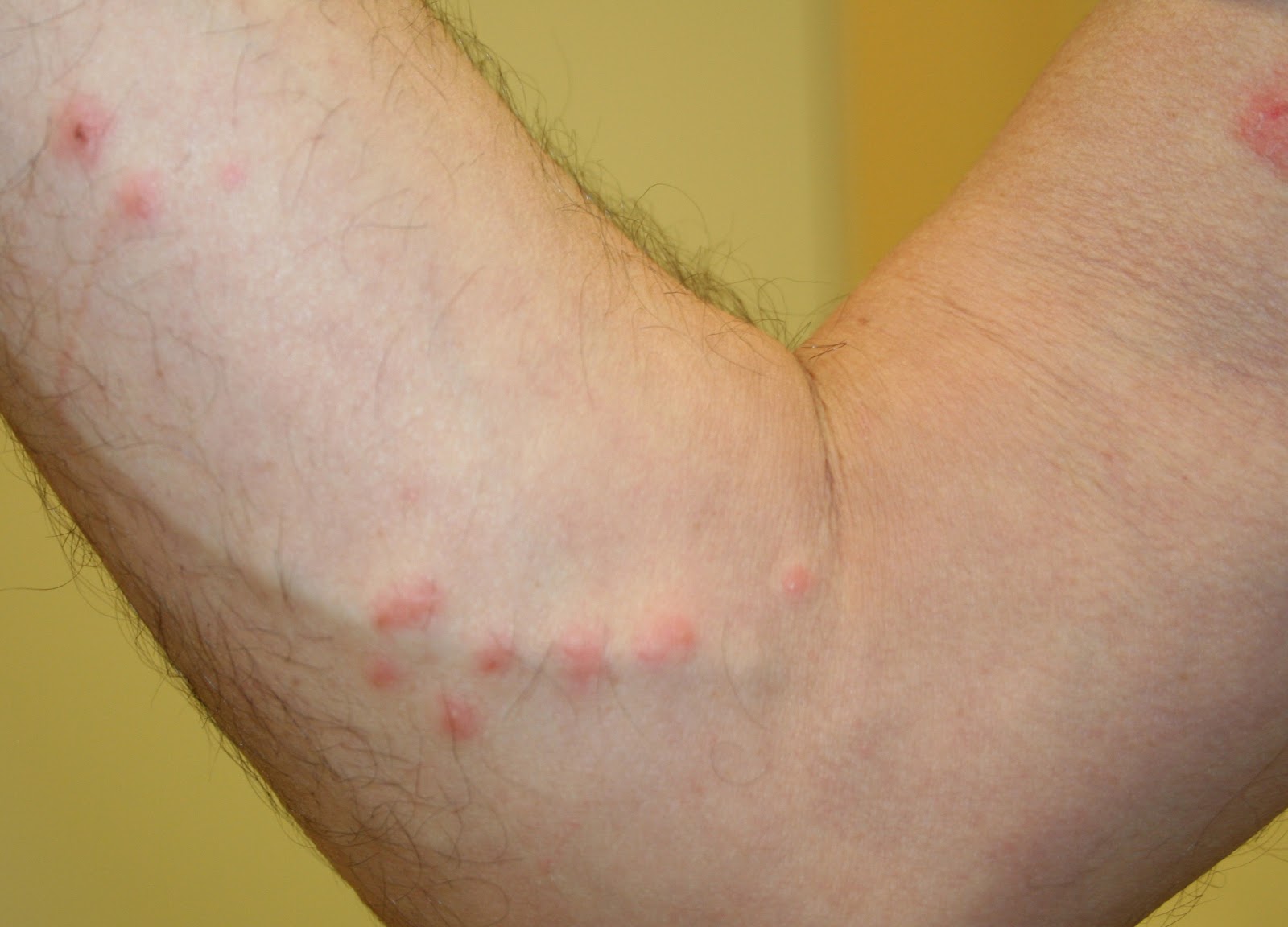 Linear bug bites - Doctor answers on HealthcareMagic