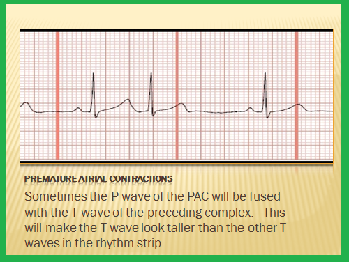 telemetry technician course premature beats premature ekg graph paper