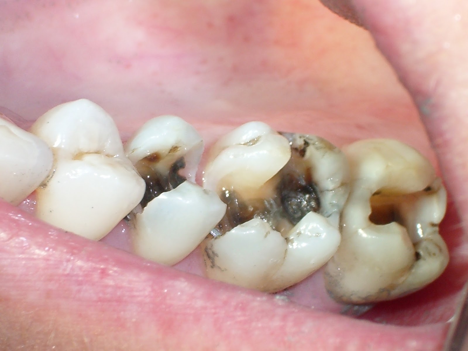 Sâu răng và cách điều trị khỏi dứt điểm chỉ sau vài phút ~ PHƯƠNG PHÁP