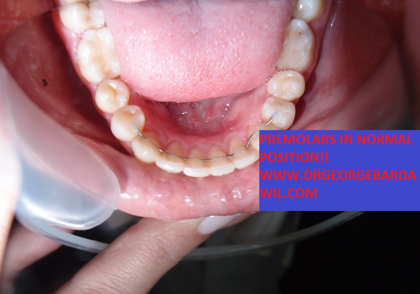 E. BardawilOrthodontistInvisalign Diamond level Rotated