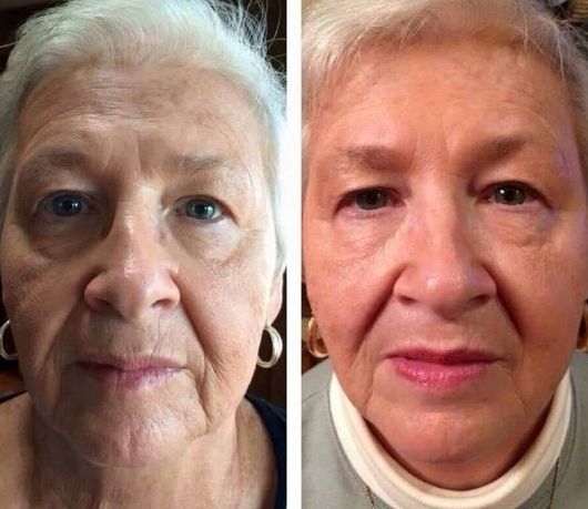 Face Workouts To Lift And Tauten Sagging Jowls And Slack Face Skin