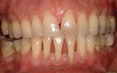 Tẩy trắng răng nhiễm thuốc kháng sinh Tetracycline