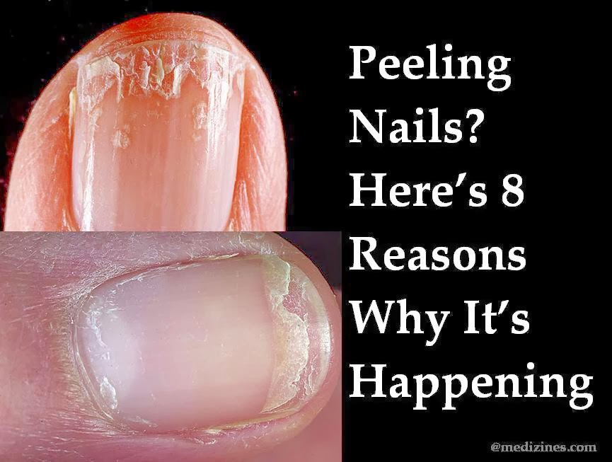 Peeling Nails? Here’s 8 Reasons Why It’s Happening