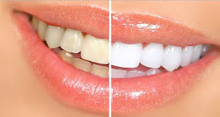 Cara Memutihkan Gigi secara Alami