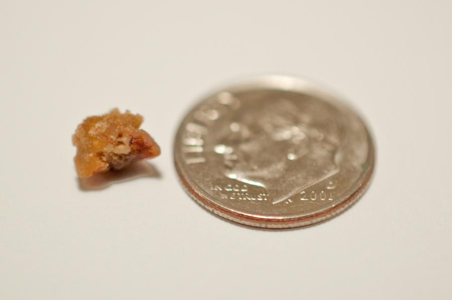 actual kidney stone size chart