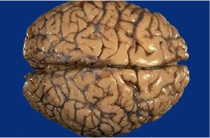 Life After Being A Student - My Mission To Learn: Neurological Diseases