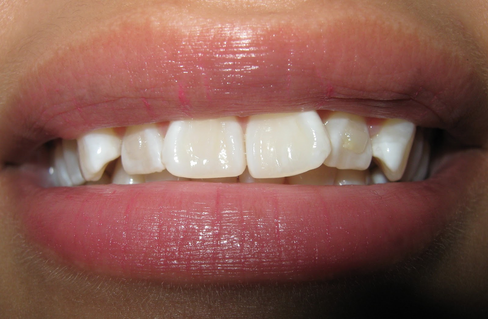 Brndy's Invisalign Journey Tray 8