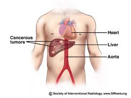 Liver Cancer Picture