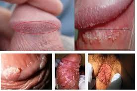 Daftar Obat Kutil Kelamin Kondiloma di Apotik Daftar Obat Kutil Kelamin Kondiloma di Apotik