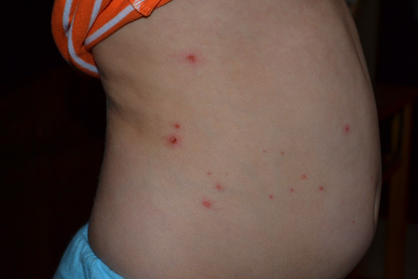 chicken pox rash image