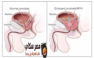 ماذا تعرف عن سرطان البروستاتا وأهم النصائح للوقاية منه Prostate Cancer