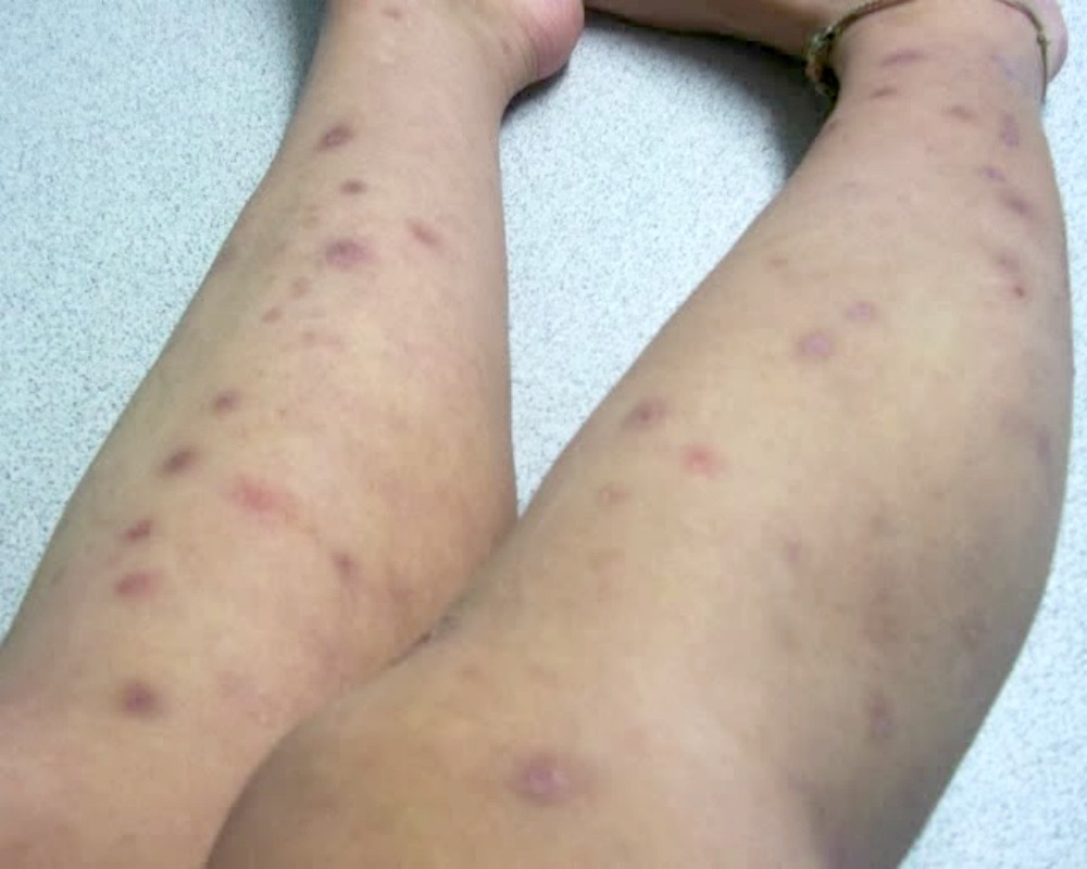suffering from eczema scars whimsical mumblings