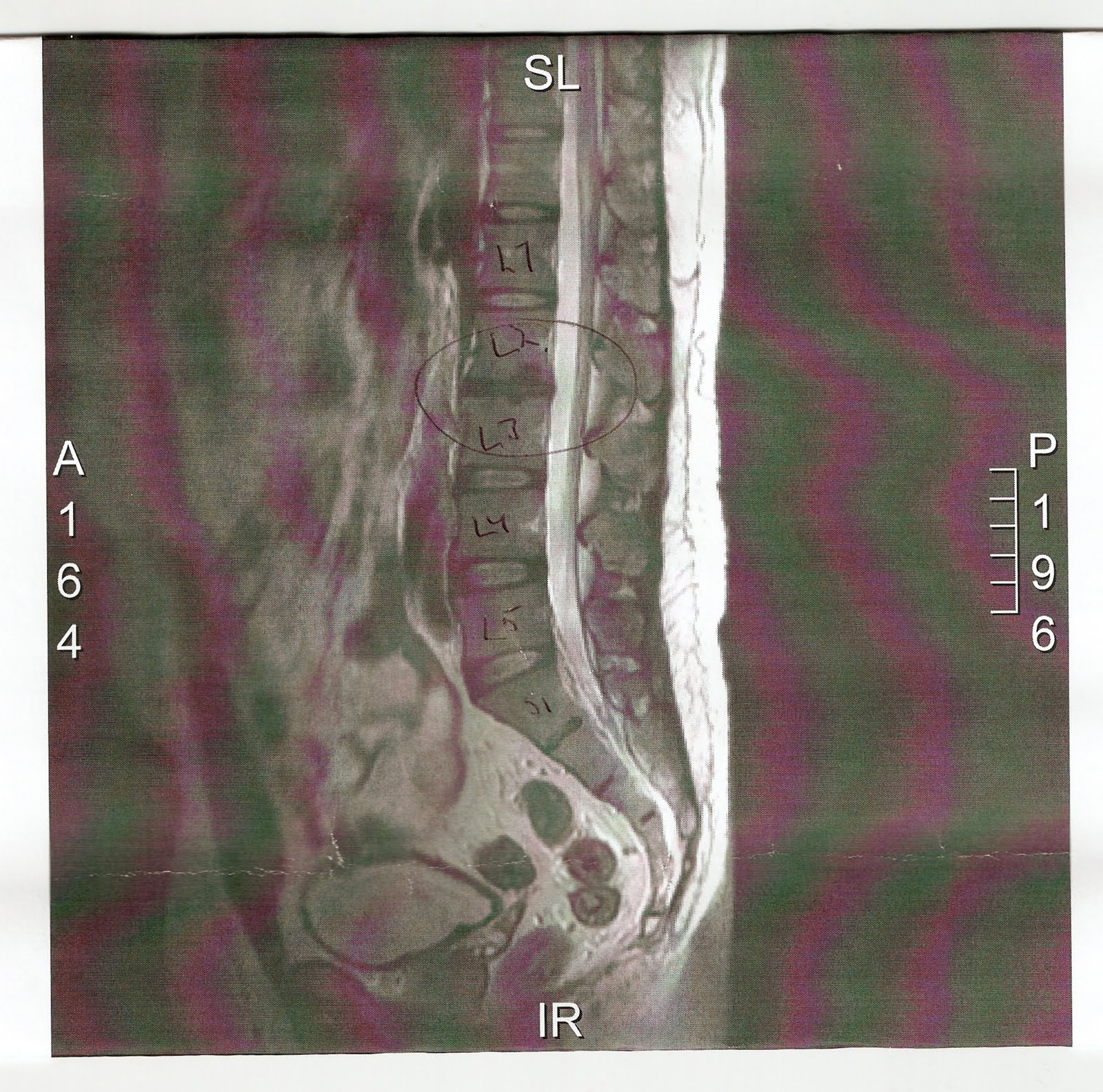 Schmorl'S Node Surgery: Realistic Recovery Time & Pain Management - xolu76b
