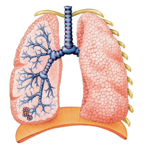 a tüdőrák átterjed A hólyagrák okai