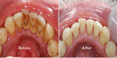 before and after dental calculus remover before and after dental calculus remover
