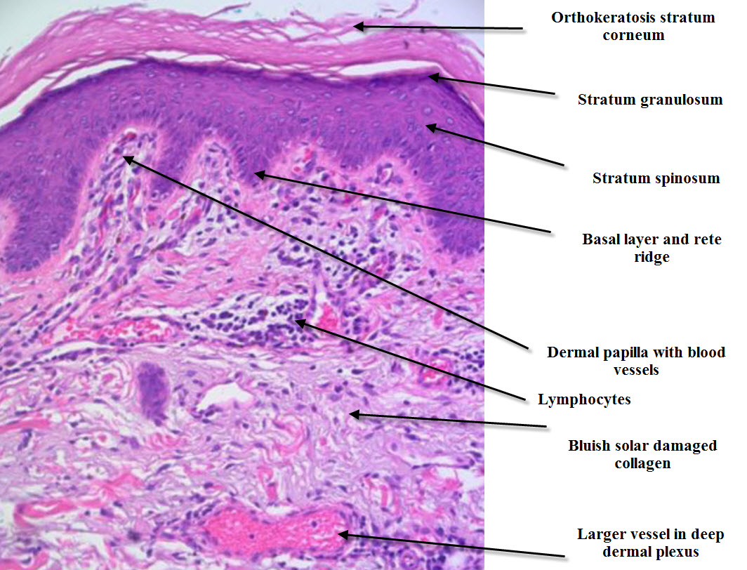 Lichen Planus: Symptoms, Diagnosis, Treatment, and Risks