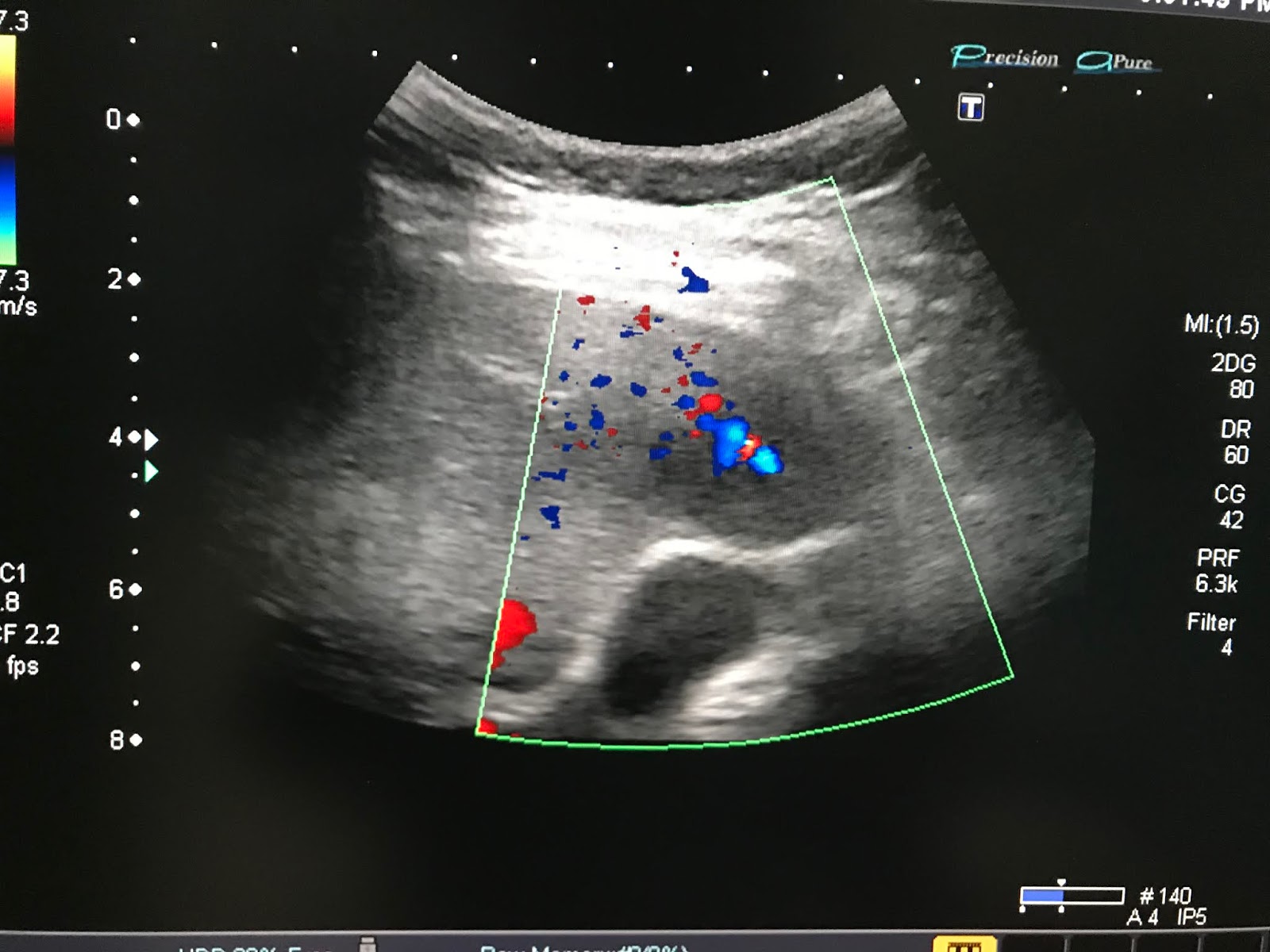 VIETNAMESE MEDIC ULTRASOUND CASE 528 LIVER TUMOR, Dr PHAN THANH HAI