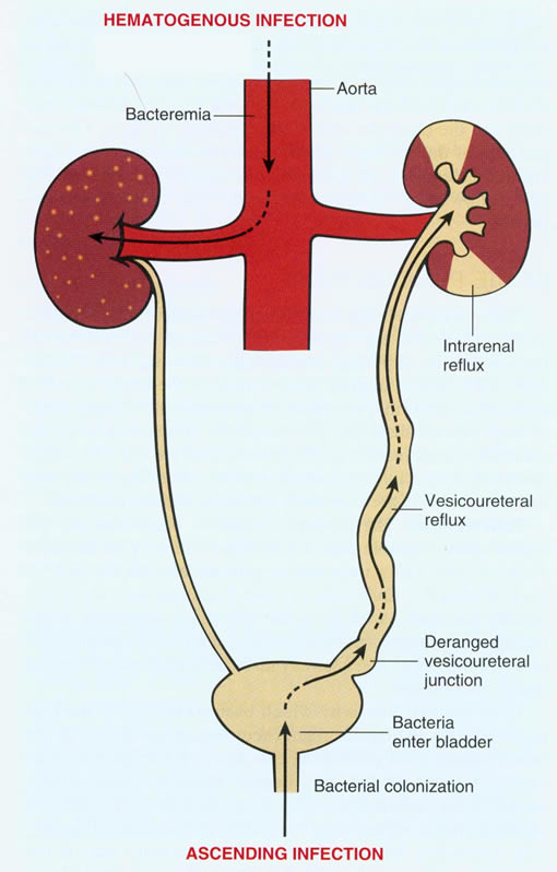 About Health Kidney Infections