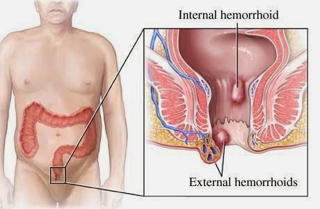 hemoroid, Penyebab hemoroid, obat hemoroid