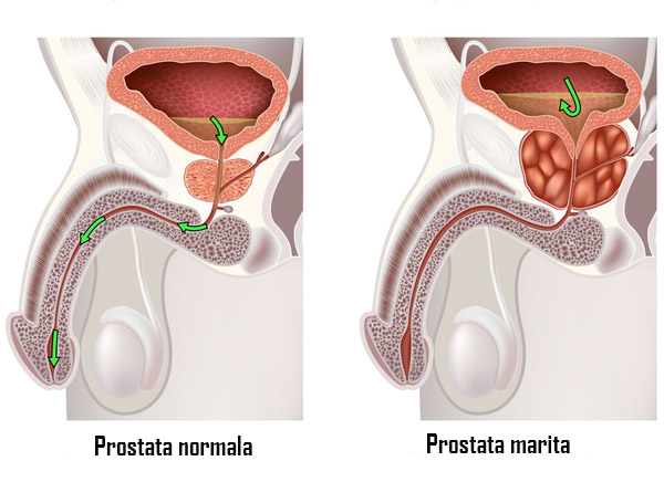 hipertermie din prostatită prostată cu prostatită cronică