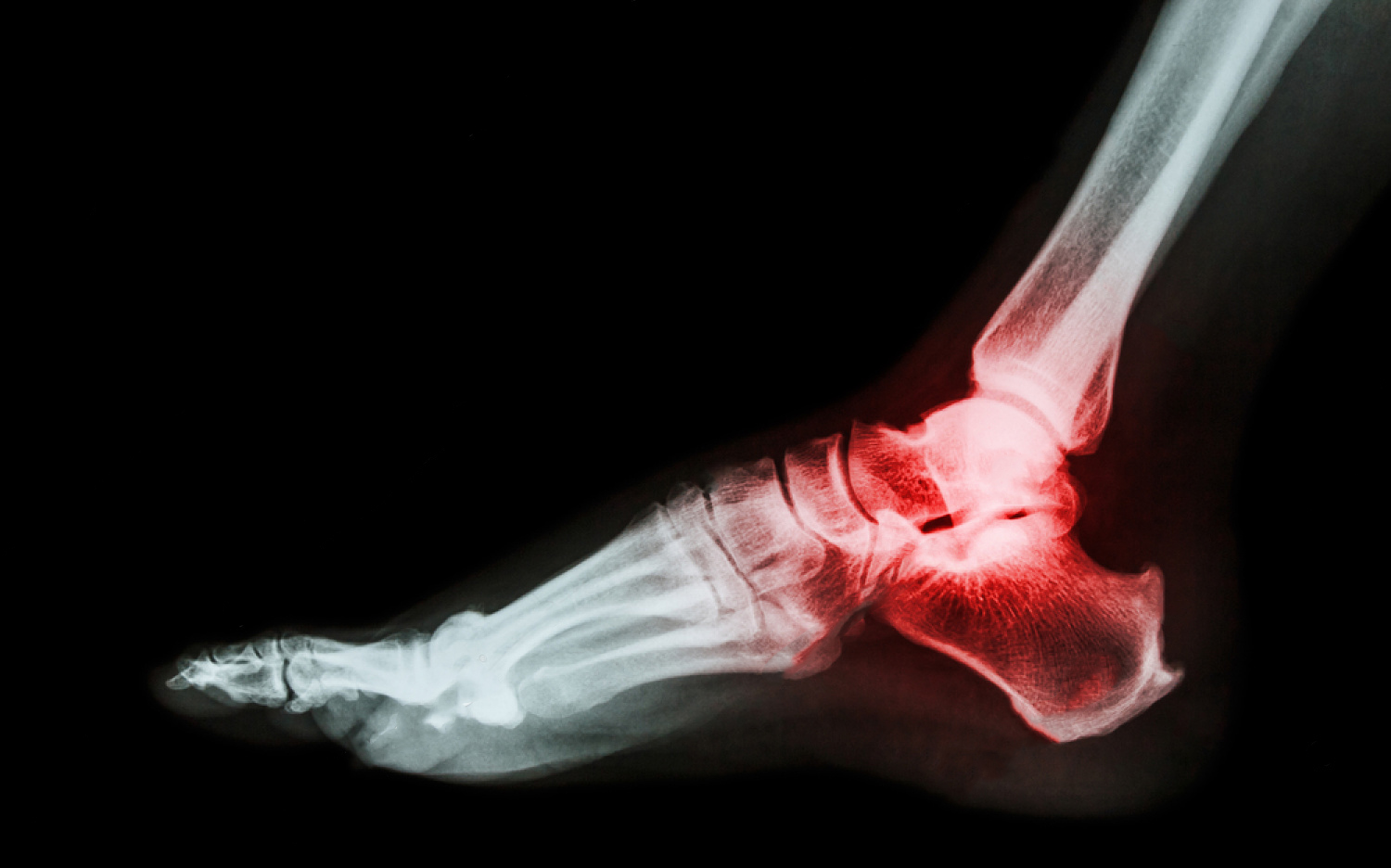Beyond Physical Therapy - Your Solution for Foot Pain in Franklin , TN