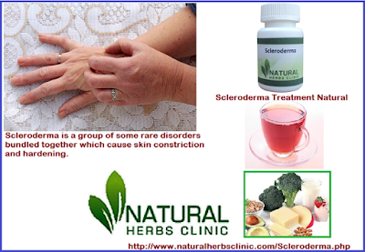 Herbal Treatment for Scleroderma