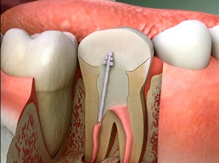Trám răng lấy tủy thực hiện như thế nào
