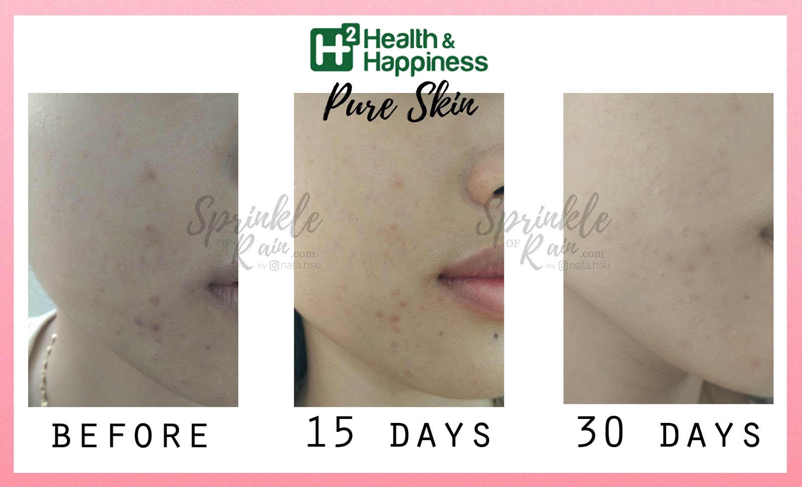 Review H2 Pure Skin Solusi Atasi Jerawat Sprinkle Of Rain