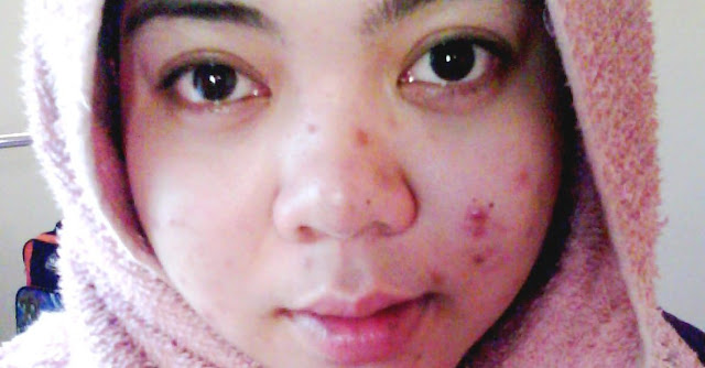 4 Hal Tak Terduga Penyebab Jerawat Tumbuh Lagi, Apa Saja ?