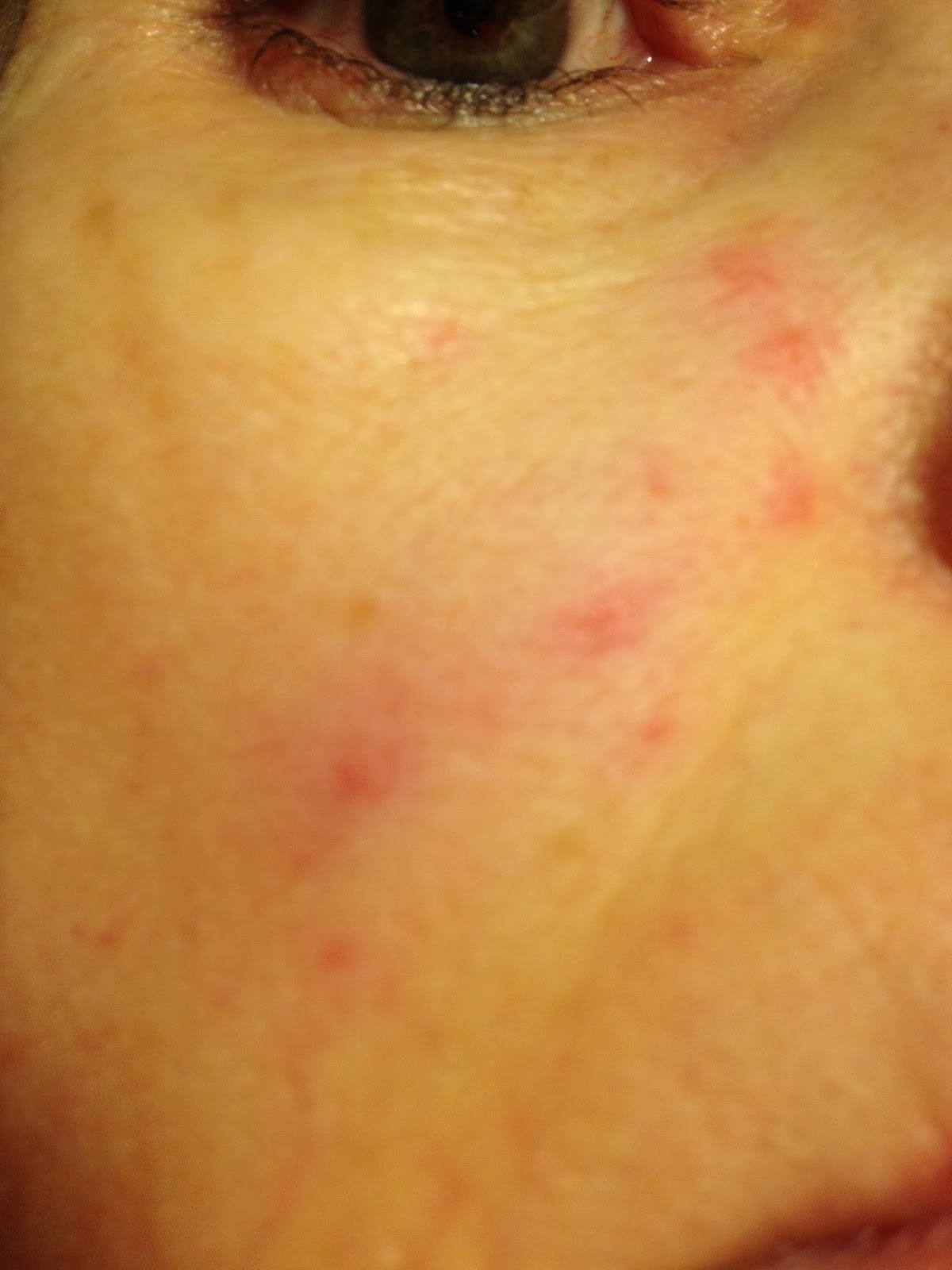 Sucrolose Allergy : Splenda Sucrolose Allergy
