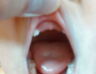 6歳児の上の前歯、抜けた歯