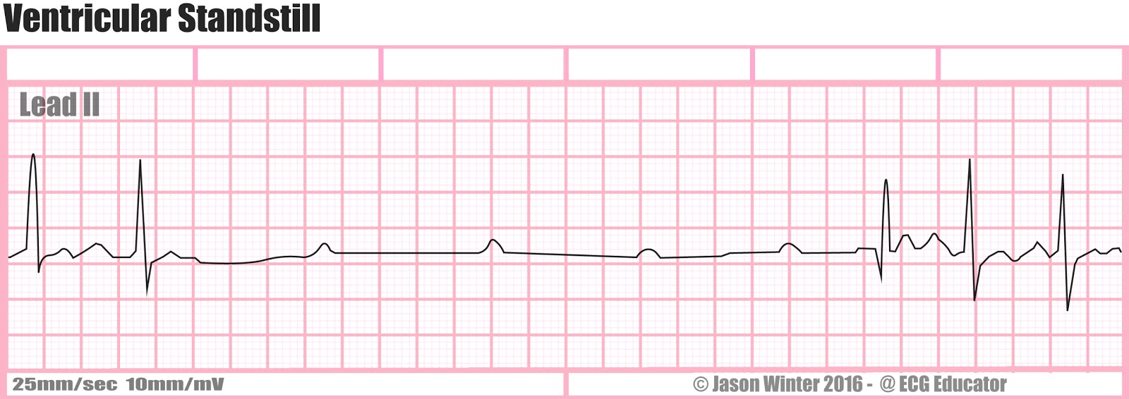 ventricular standstill strips Sexy emo amy tube