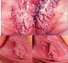 Foto Tips dan Cara Aman Mengobati Tumbuh Daging Kecil Berwarna Atau Pembengkakan Abu-abu Di Daerah Genital